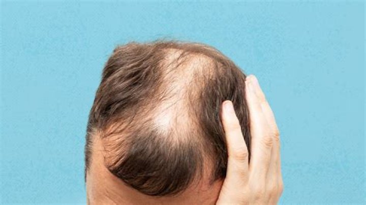 Embracing Baldness: The Journey Of Bald Ppl